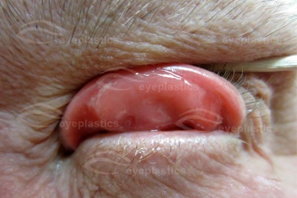 Close-up of the lax upper eyelid everting โ soft rubbery tarsus