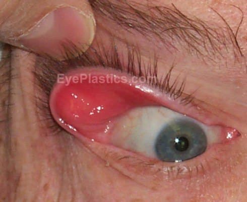 Easy eversion of the upper eyelid with only minimal upward traction โ the hallmark sign of floppy eyelid syndrome