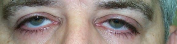 Lash ptosis โ downward-pointing upper lashes