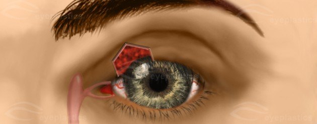 Pentagonal Wedge Resection โ Tightening the Lax Upper Eyelid โ slide 1 of 4